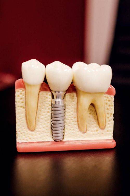Wurzelentzündung und toter Zahn: Alternative Rettung vor dem Zahn-Ziehen